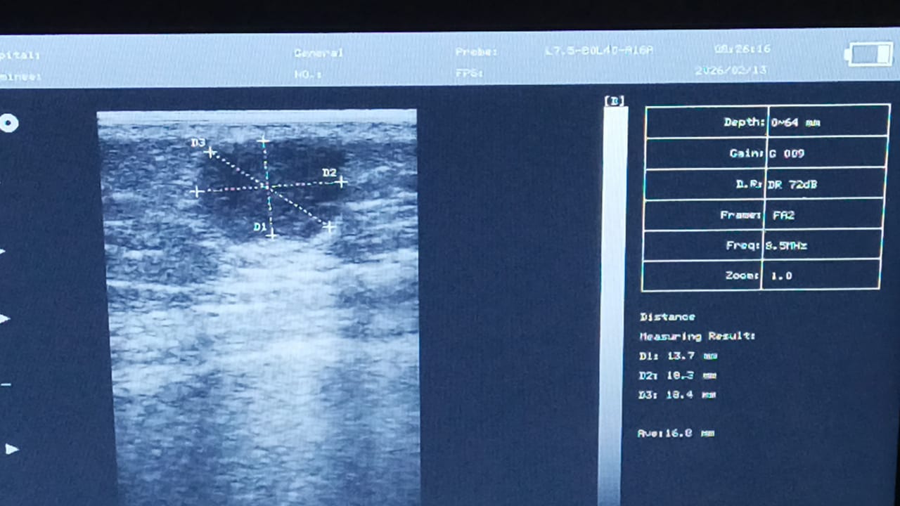 Exéresis de Quiste Sebáceo