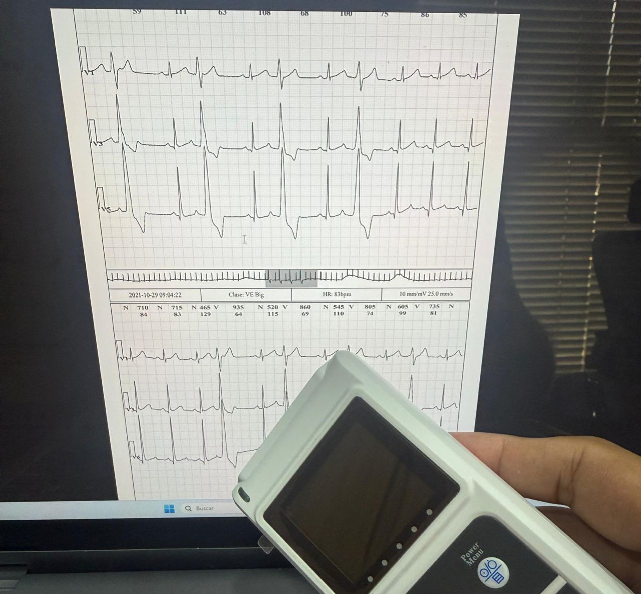 Bigeminismo en Holter